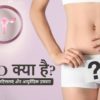 PCOD Kya hai